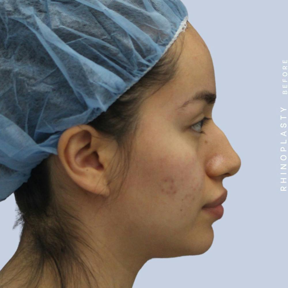 Nose Before & After Gallery - Patient 120868135 - Image 7