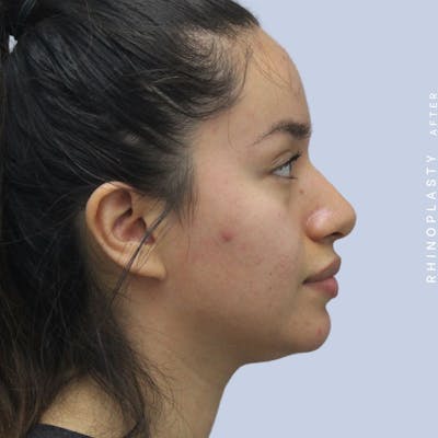 Nose Before & After Gallery - Patient 120868135 - Image 8
