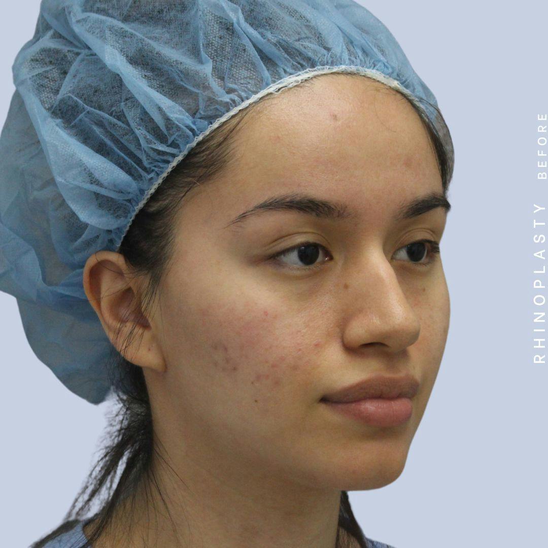 Nose Before & After Gallery - Patient 120868135 - Image 9