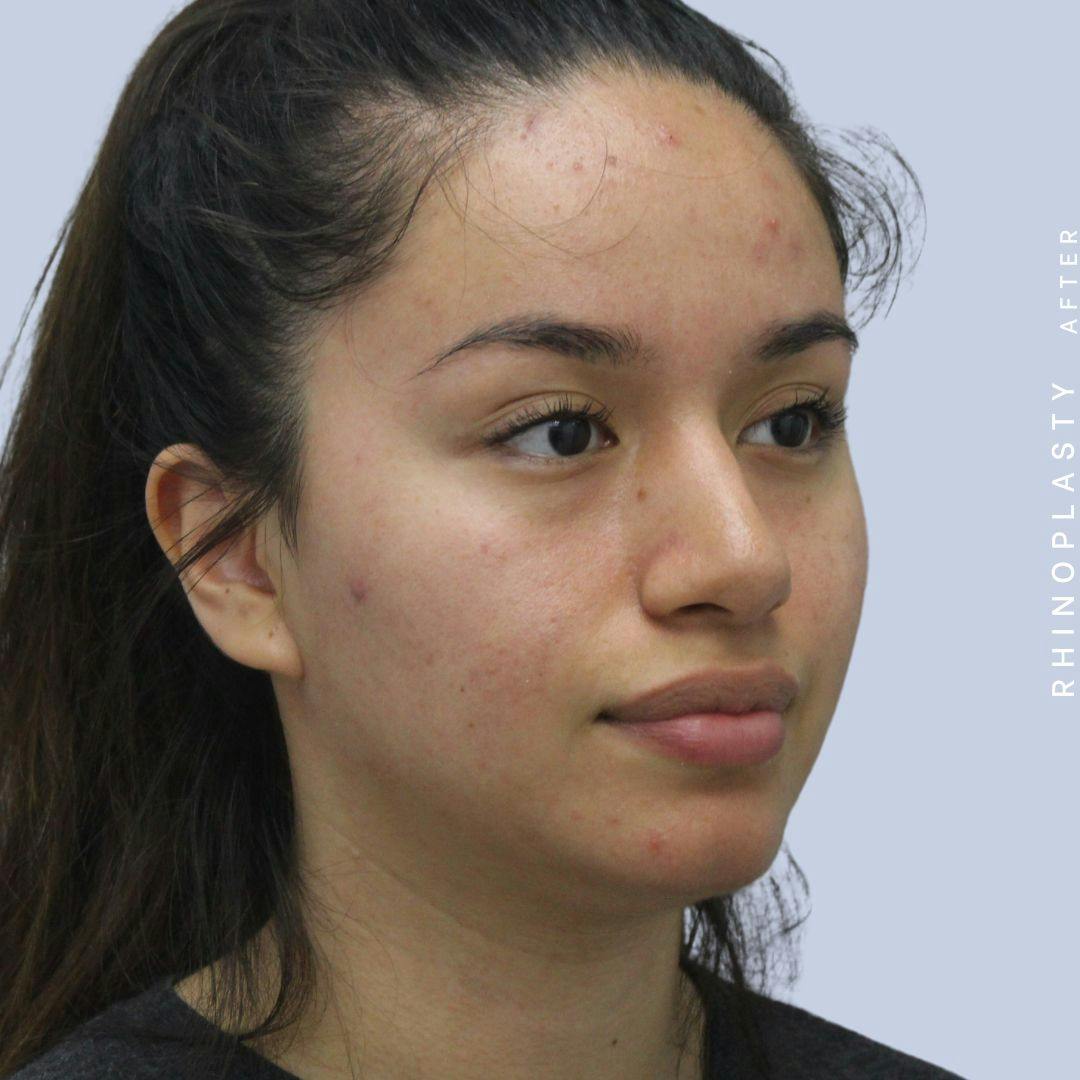 Nose Before & After Gallery - Patient 120868135 - Image 10