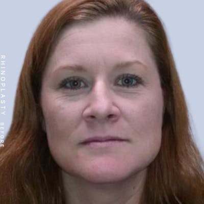 Nose Before & After Gallery - Patient 121123666 - Image 1