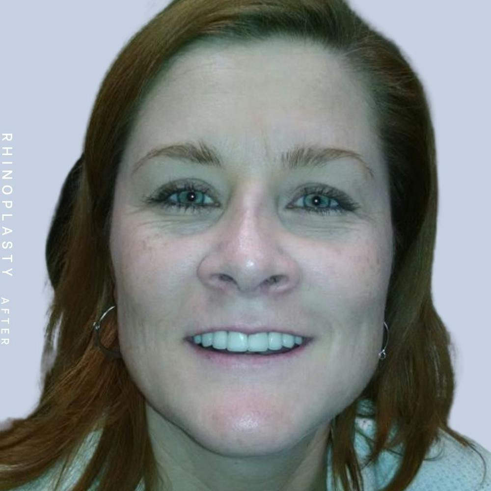 Nose Before & After Gallery - Patient 121123666 - Image 2