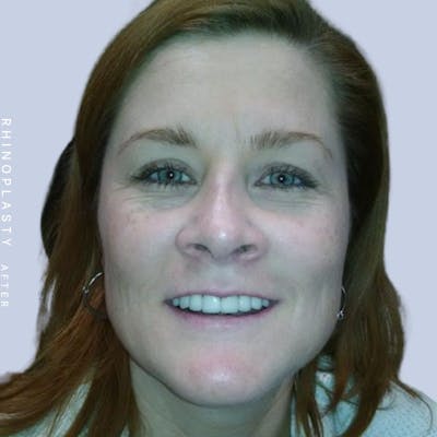 Nose Before & After Gallery - Patient 121123666 - Image 2