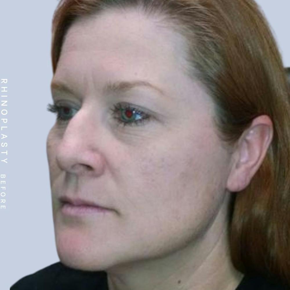 Nose Before & After Gallery - Patient 121123666 - Image 3