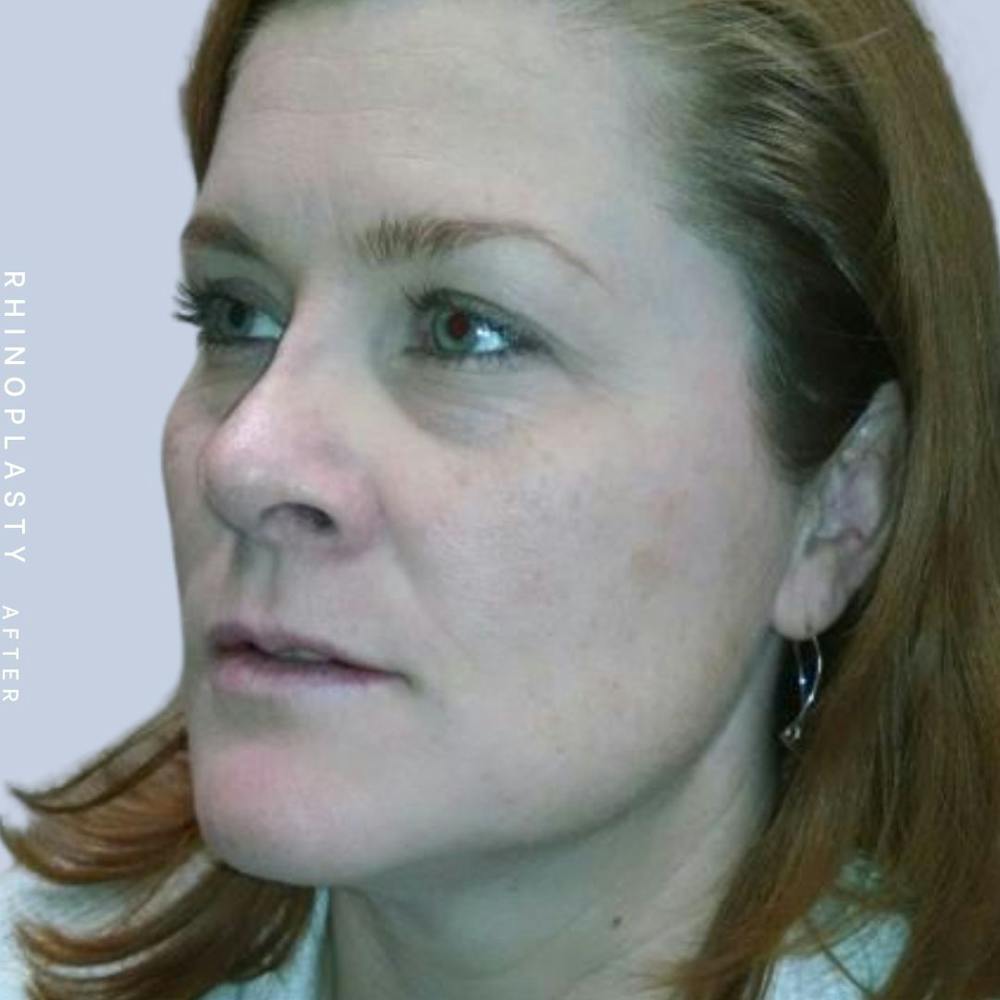 Nose Before & After Gallery - Patient 121123666 - Image 4