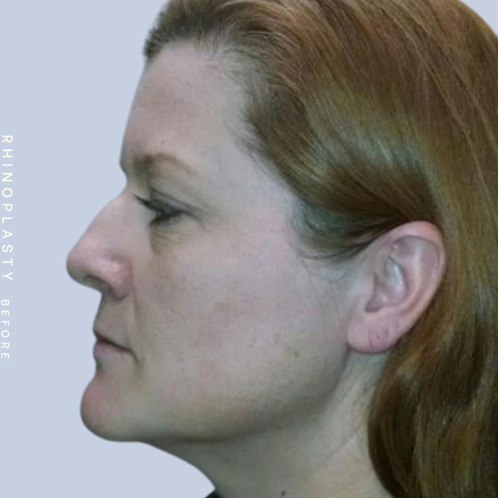 Nose Before & After Gallery - Patient 121123666 - Image 5