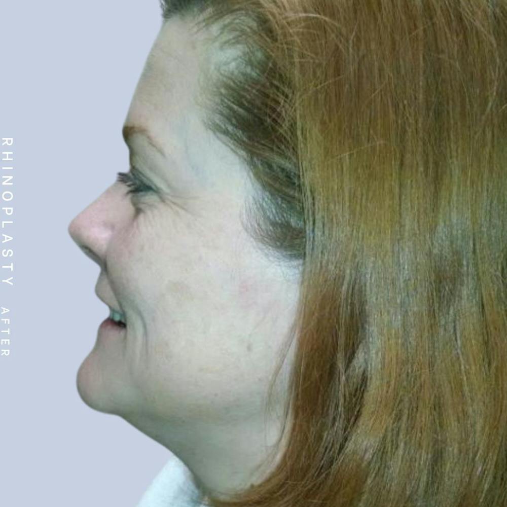 Nose Before & After Gallery - Patient 121123666 - Image 6