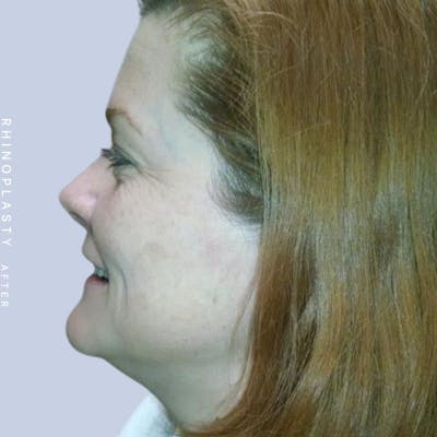 Nose Before & After Gallery - Patient 121123666 - Image 6
