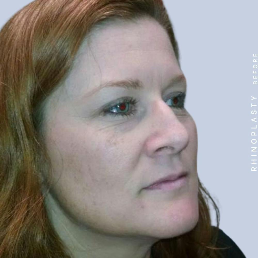 Nose Before & After Gallery - Patient 121123666 - Image 7