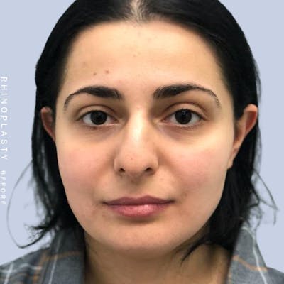 Nose Before & After Gallery - Patient 121439109 - Image 1
