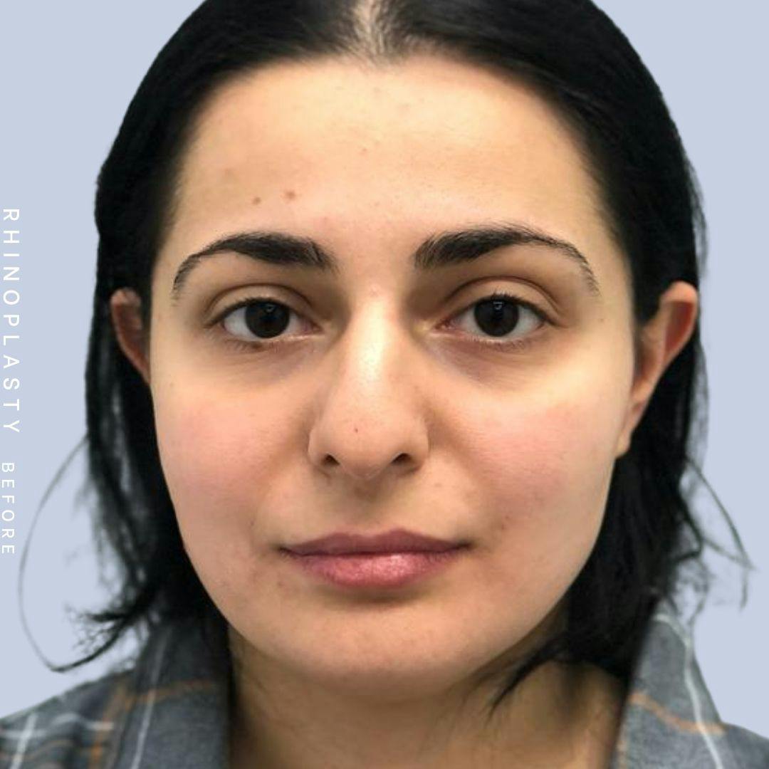 Nose Before & After Gallery - Patient 121439109 - Image 1