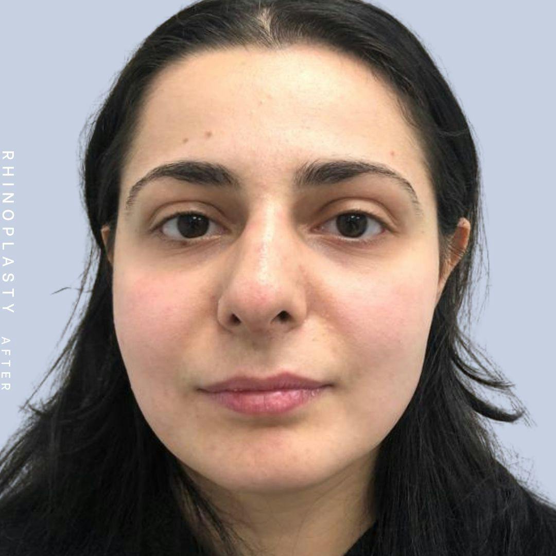 Nose Before & After Gallery - Patient 121439109 - Image 2