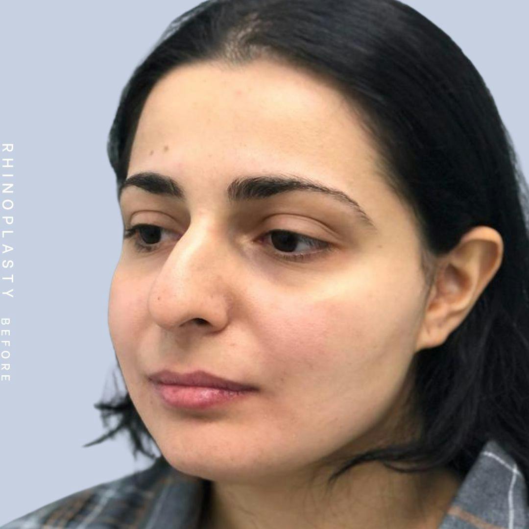 Nose Before & After Gallery - Patient 121439109 - Image 3