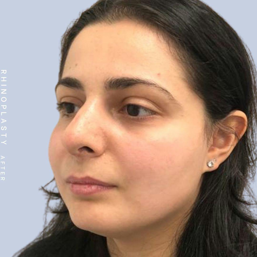 Nose Before & After Gallery - Patient 121439109 - Image 4