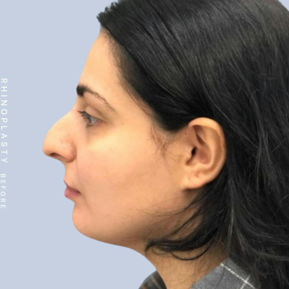 Nose Before & After Gallery - Patient 121439109 - Image 5