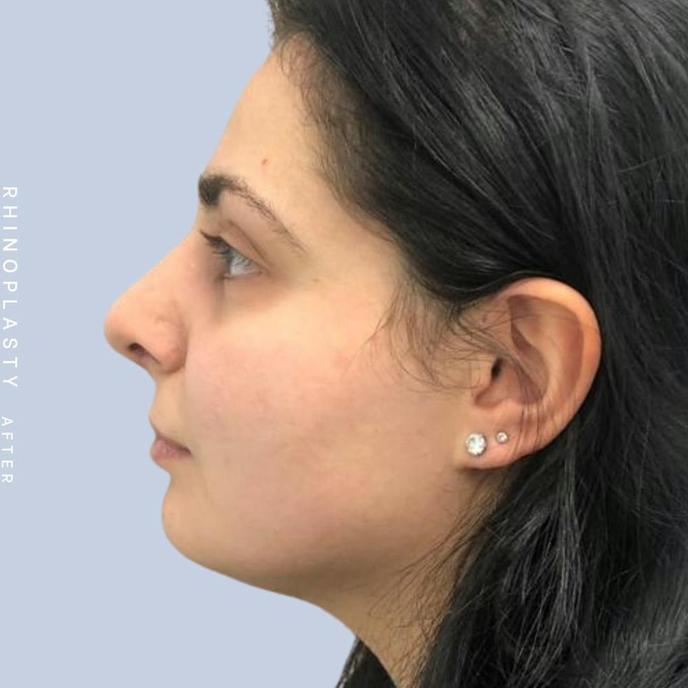 Nose Before & After Gallery - Patient 121439109 - Image 6