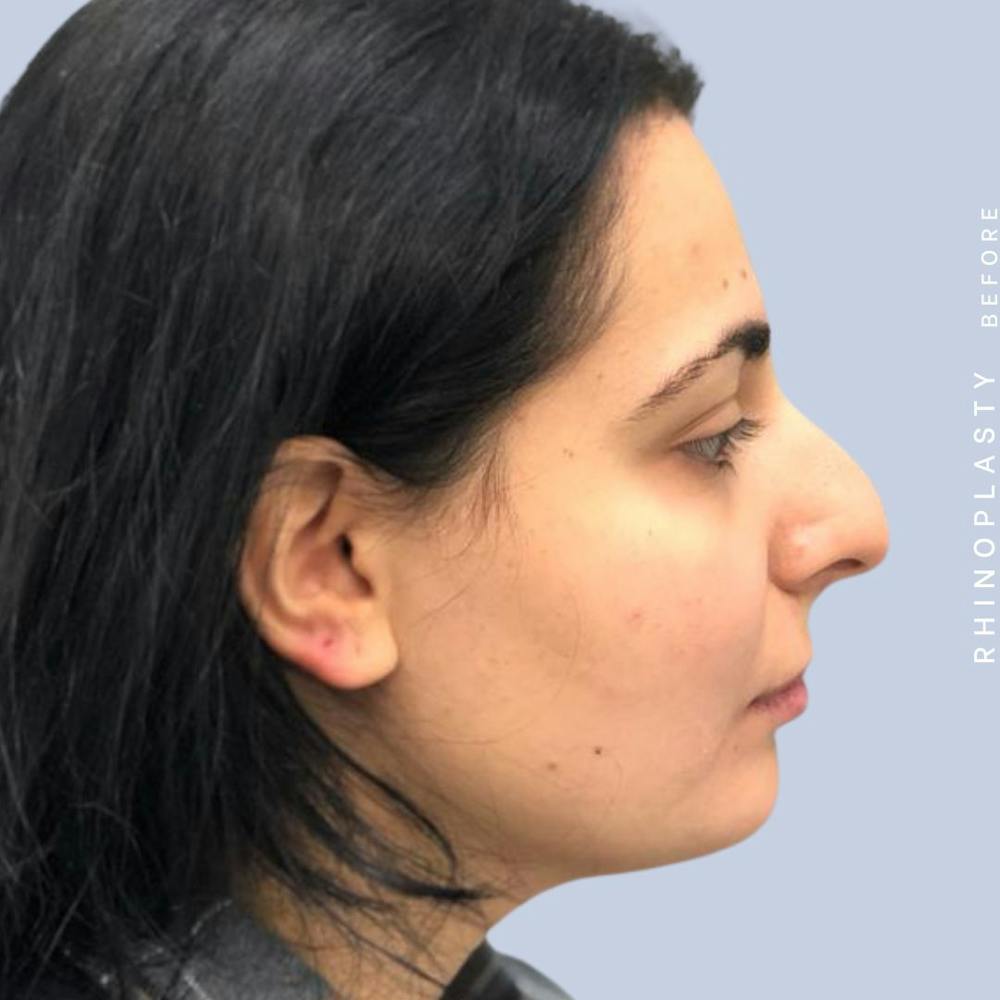 Nose Before & After Gallery - Patient 121439109 - Image 7