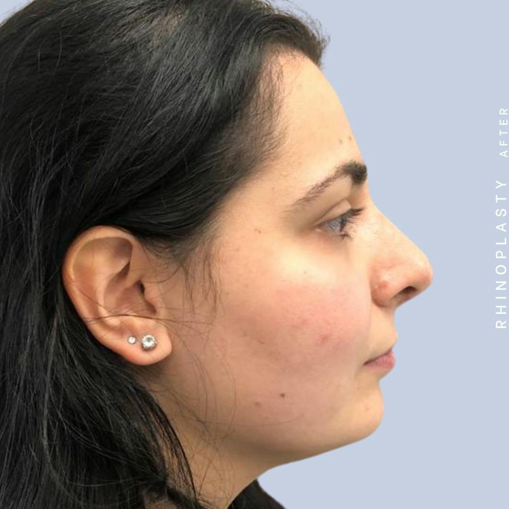 Nose Before & After Gallery - Patient 121439109 - Image 8