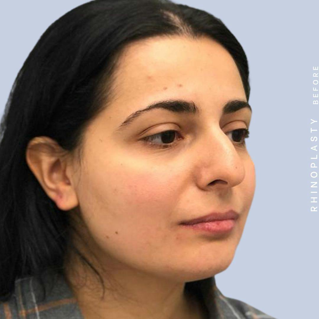 Nose Before & After Gallery - Patient 121439109 - Image 9