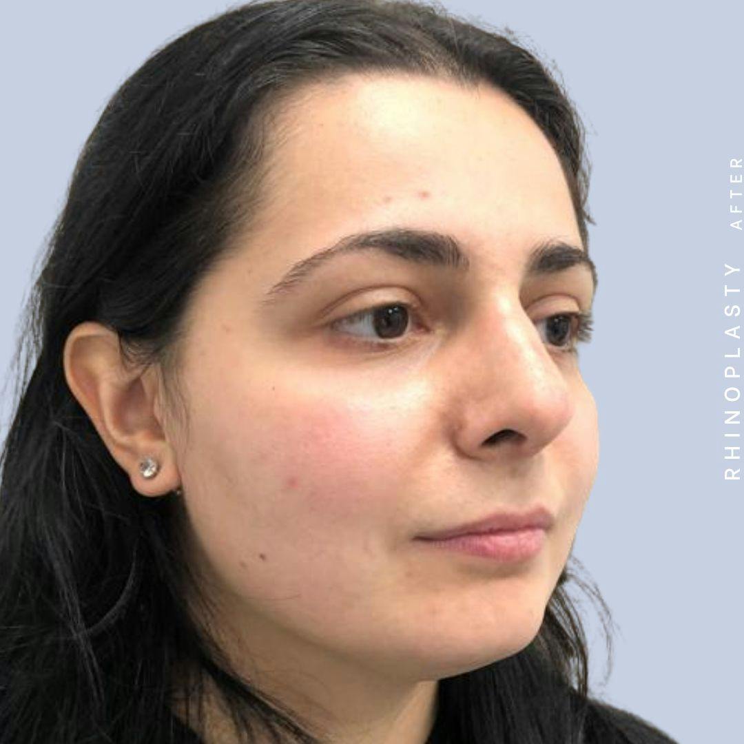 Nose Before & After Gallery - Patient 121439109 - Image 10