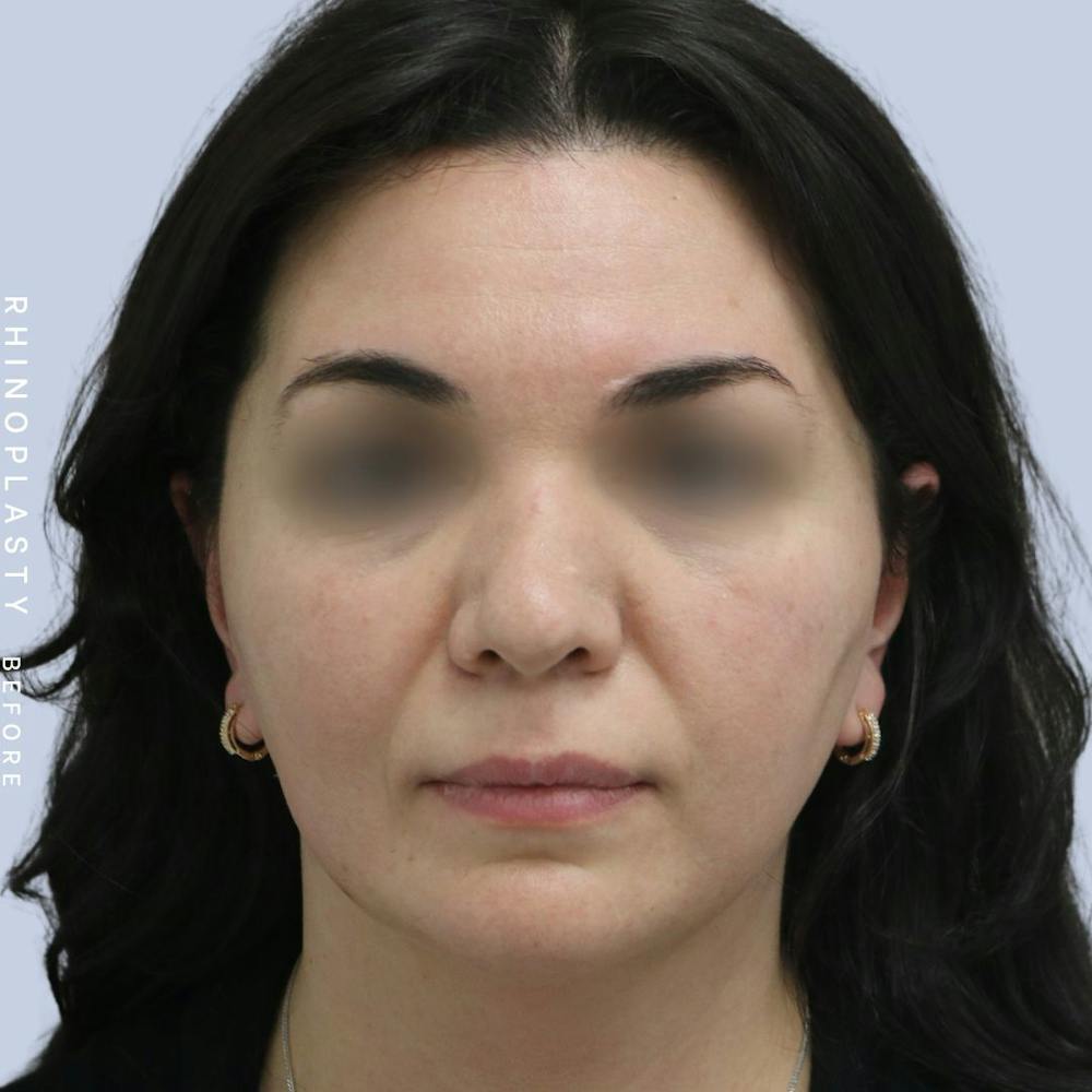 Nose Before & After Gallery - Patient 120868448 - Image 1