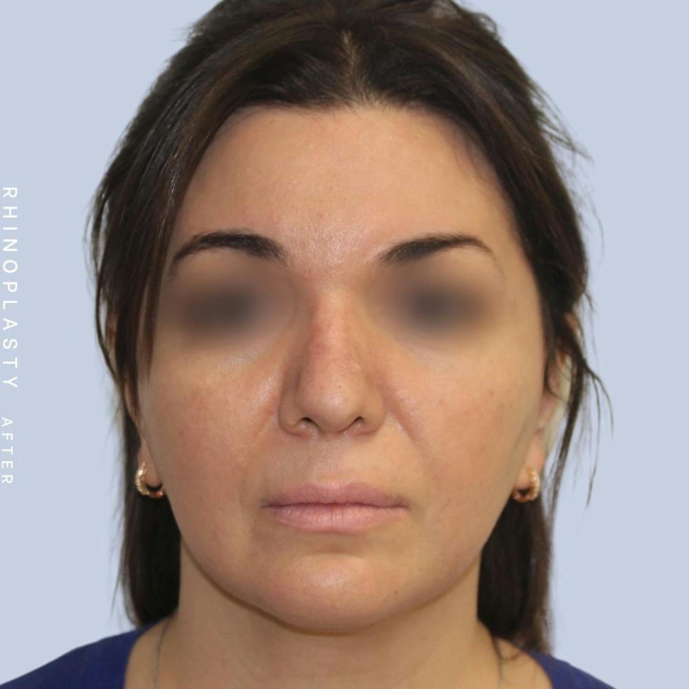 Nose Before & After Gallery - Patient 120868448 - Image 2