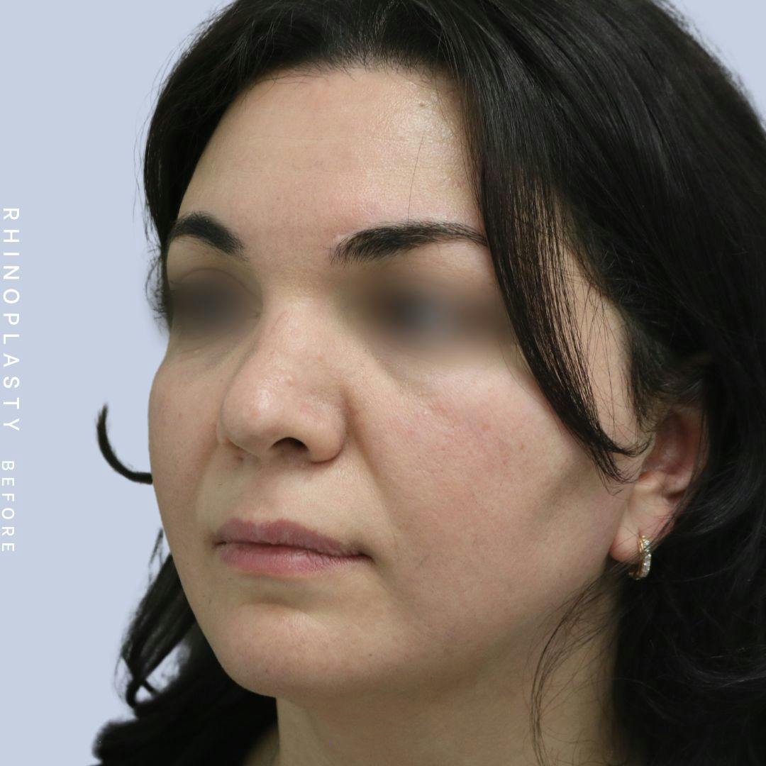 Nose Before & After Gallery - Patient 120868448 - Image 3