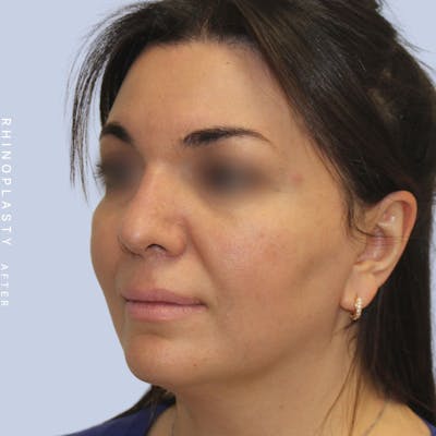 Nose Before & After Gallery - Patient 120868448 - Image 4