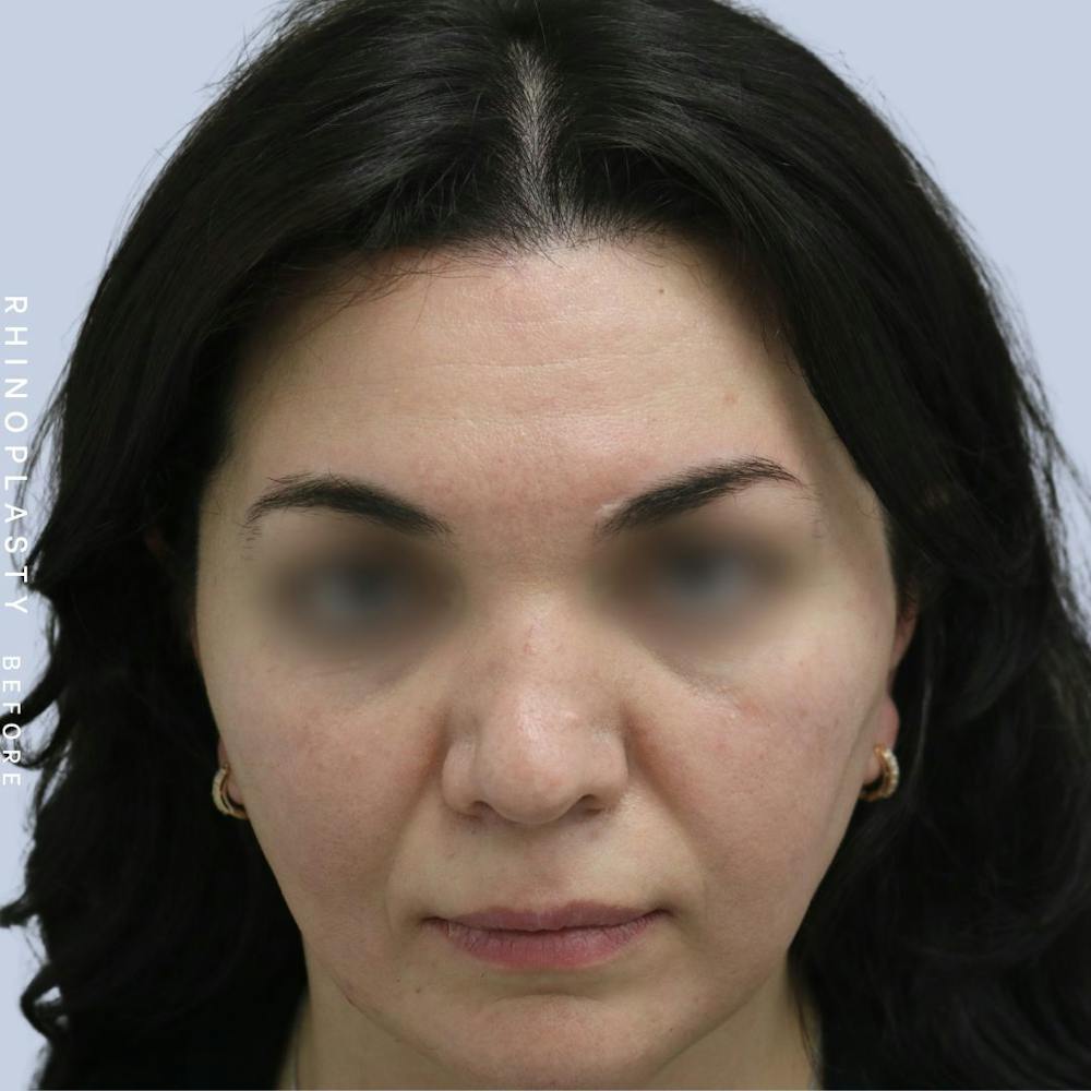 Nose Before & After Gallery - Patient 120868448 - Image 5