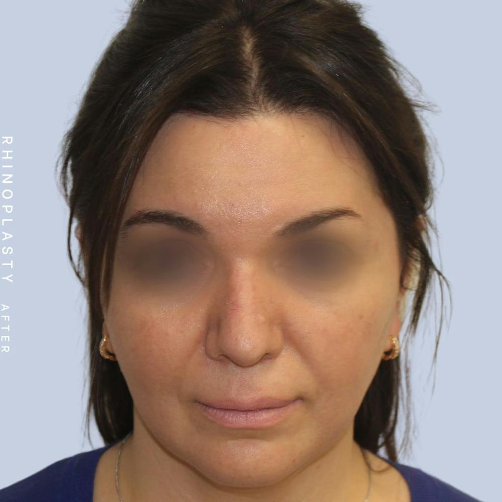 Nose Before & After Gallery - Patient 120868448 - Image 6
