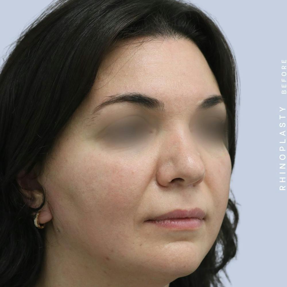 Nose Before & After Gallery - Patient 120868448 - Image 7