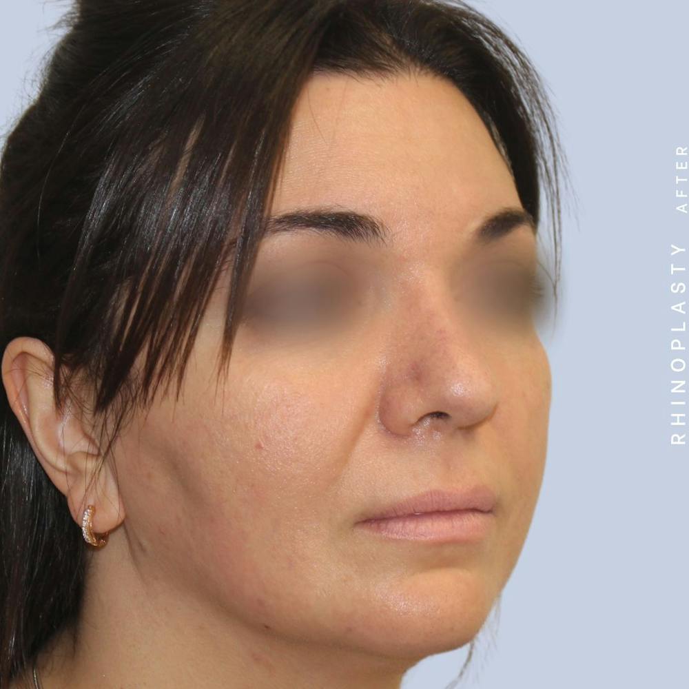 Nose Before & After Gallery - Patient 120868448 - Image 8