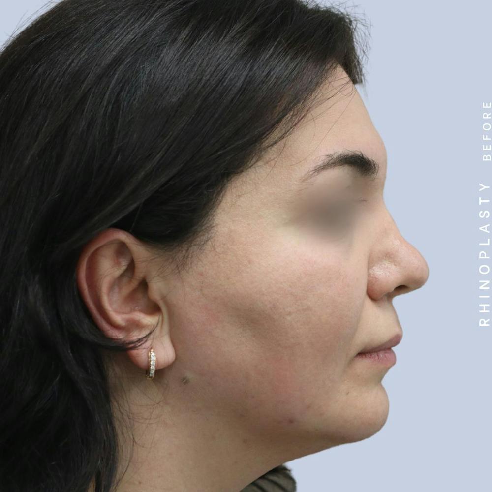 Nose Before & After Gallery - Patient 120868448 - Image 9