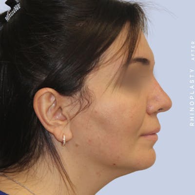 Nose Before & After Gallery - Patient 120868448 - Image 10