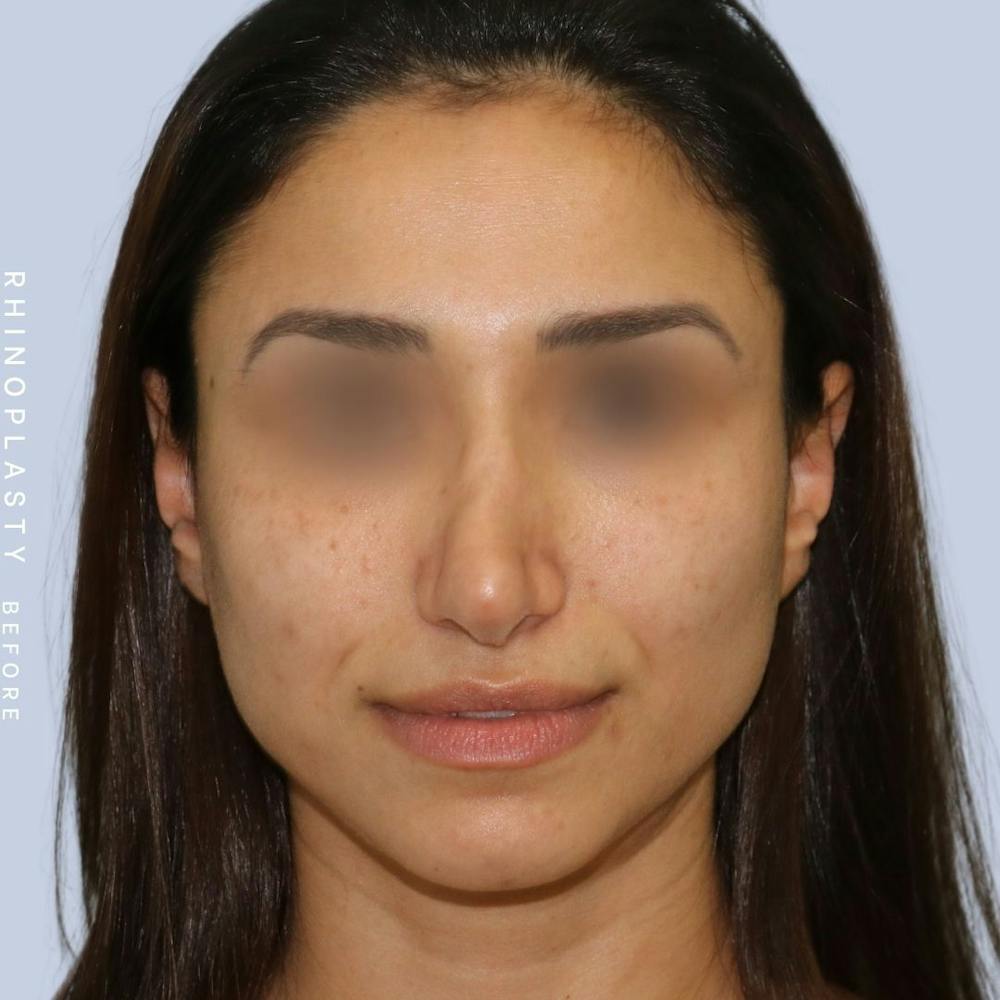 Nose Before & After Gallery - Patient 121123693 - Image 1