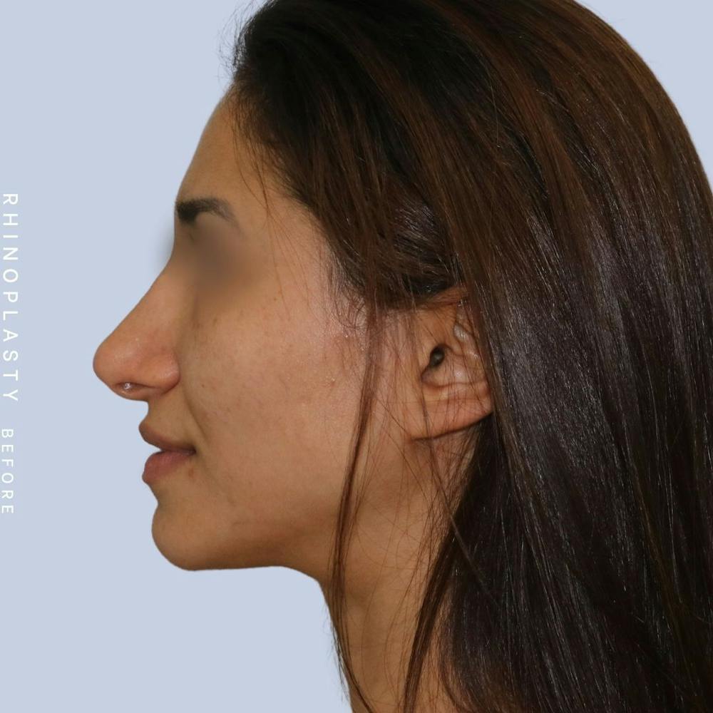 Nose Before & After Gallery - Patient 121123693 - Image 9