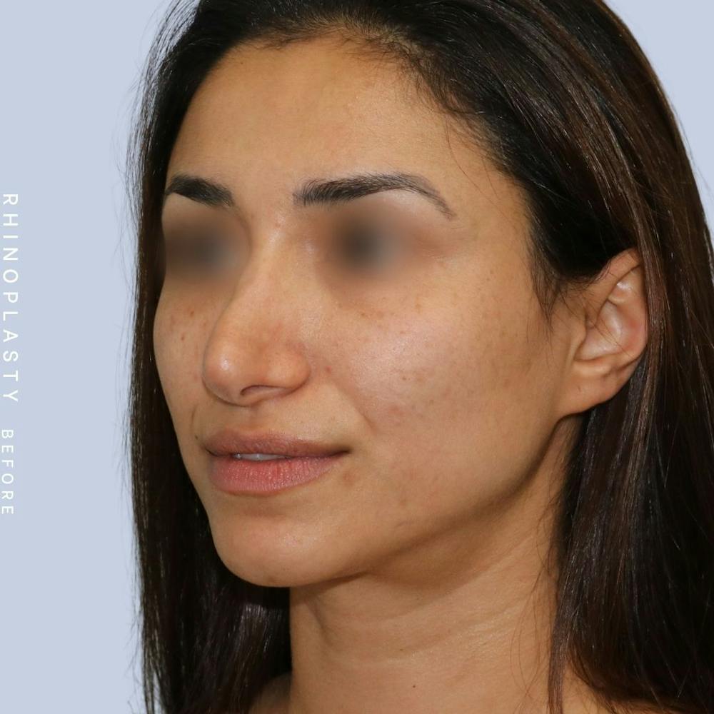 Nose Before & After Gallery - Patient 121123693 - Image 3