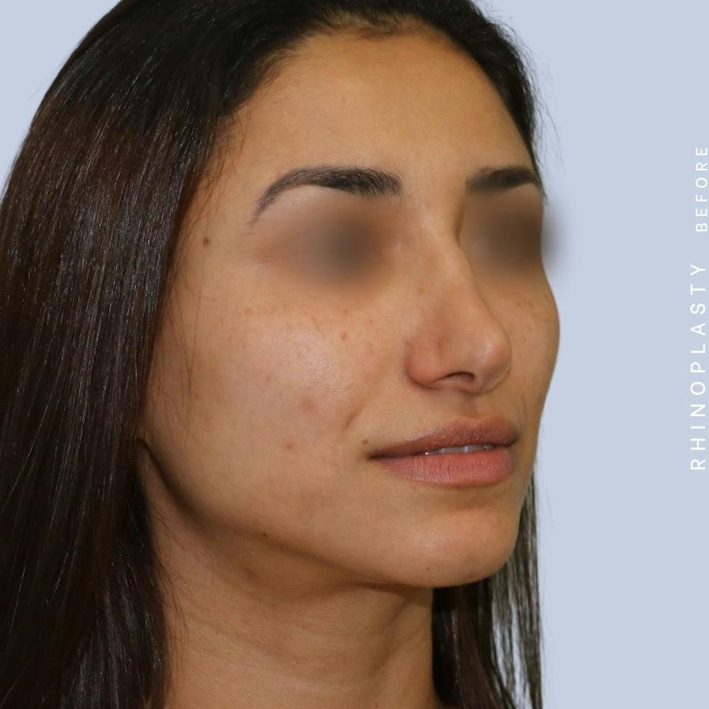Nose Before & After Gallery - Patient 121123693 - Image 5