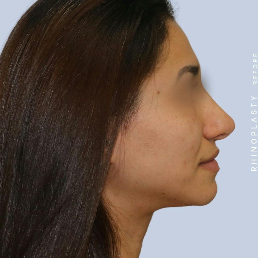 Nose Before & After Gallery - Patient 121123693 - Image 7