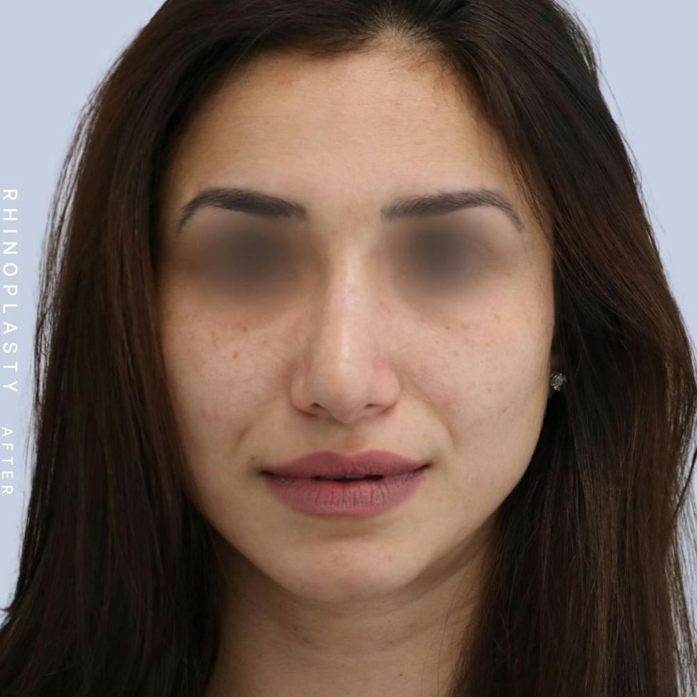 Nose Before & After Gallery - Patient 121123693 - Image 2