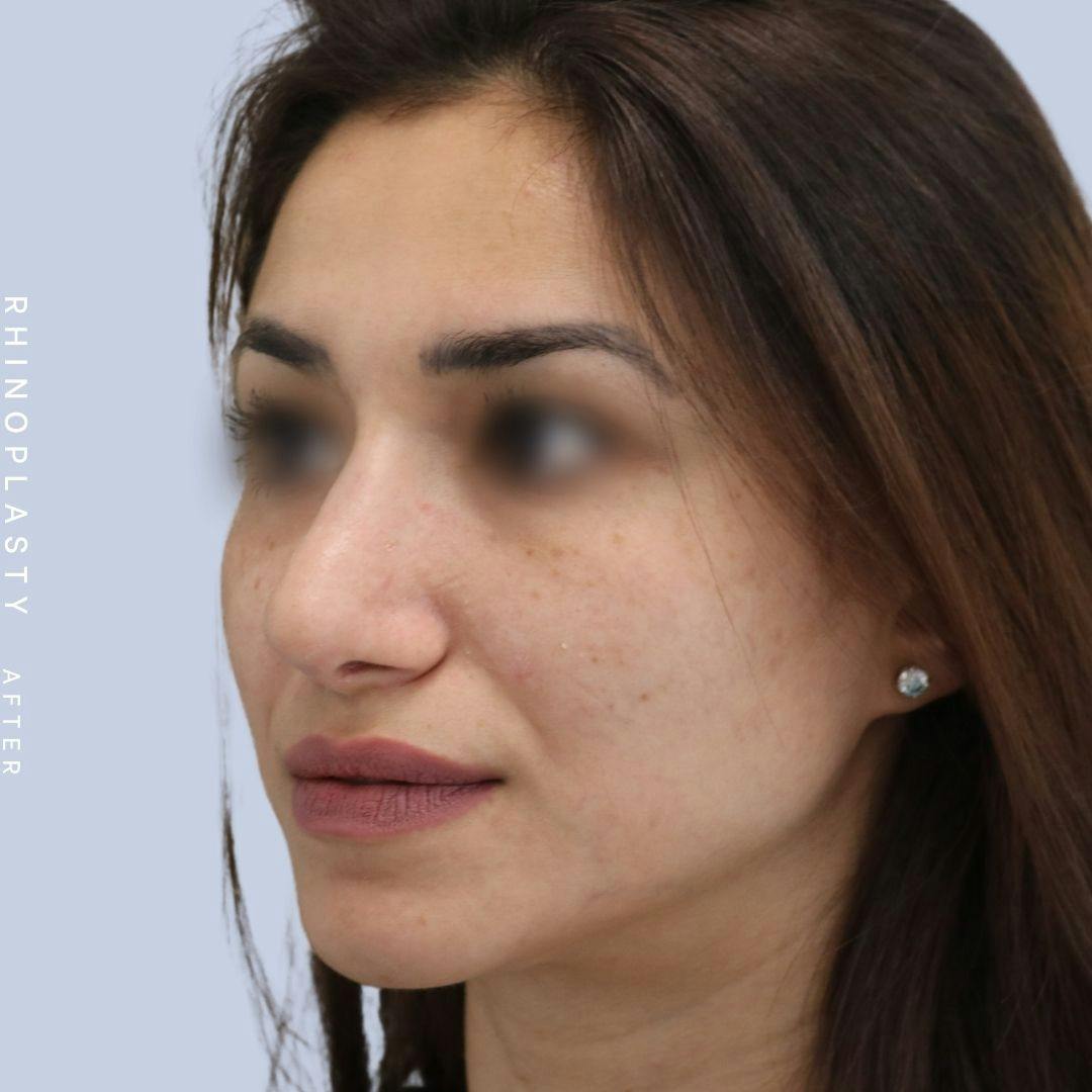 Nose Before & After Gallery - Patient 121123693 - Image 4