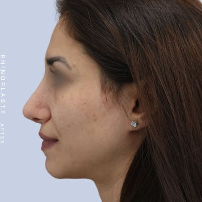 Nose Before & After Gallery - Patient 121123693 - Image 10