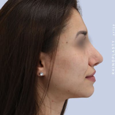 Nose Before & After Gallery - Patient 121123693 - Image 8