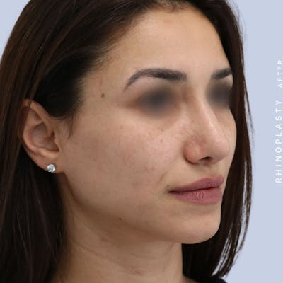 Nose Before & After Gallery - Patient 121123693 - Image 6