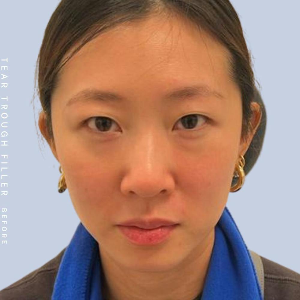 Non-Surgical Eyes Before & After Gallery - Patient 117981745 - Image 1