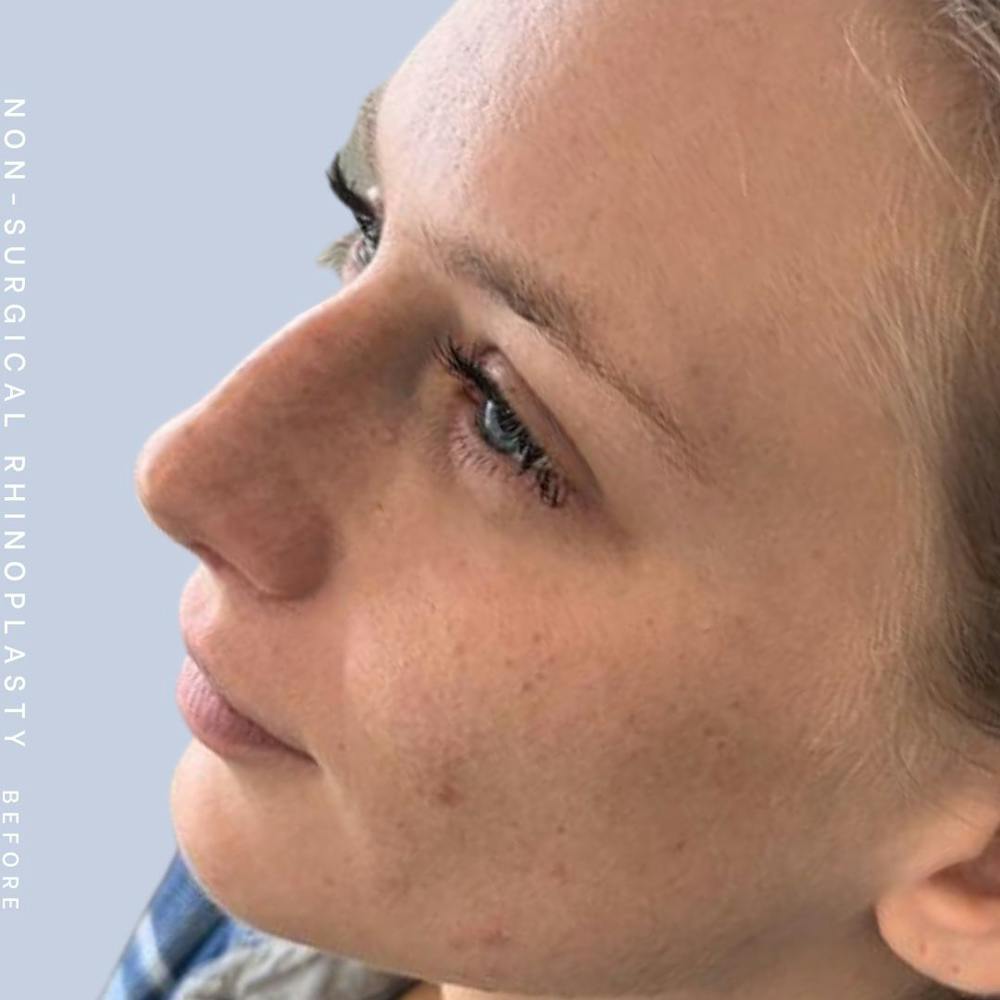 Non-Surgical Nose Before & After Gallery - Patient 142025234 - Image 1