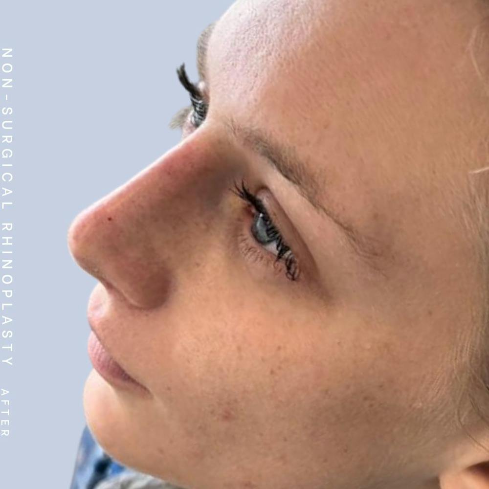 Non-Surgical Nose Before & After Gallery - Patient 142025234 - Image 2