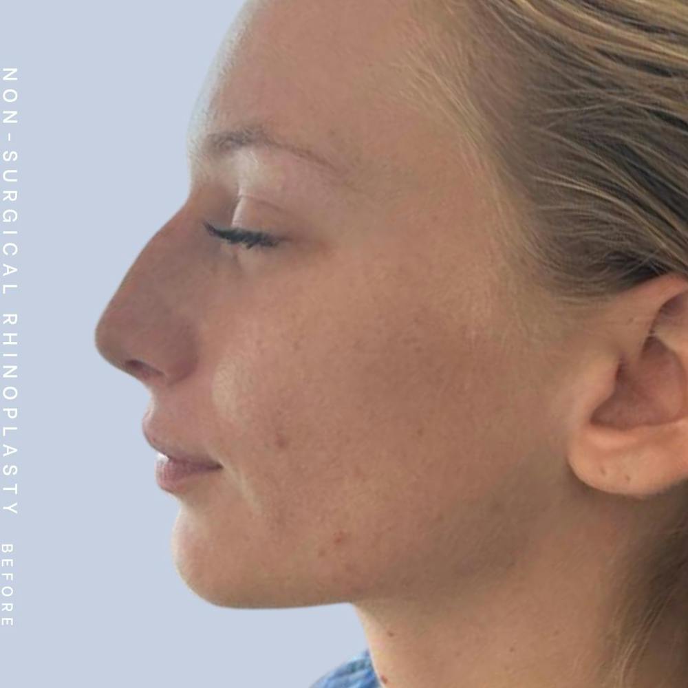 Non-Surgical Nose Before & After Gallery - Patient 142025234 - Image 3