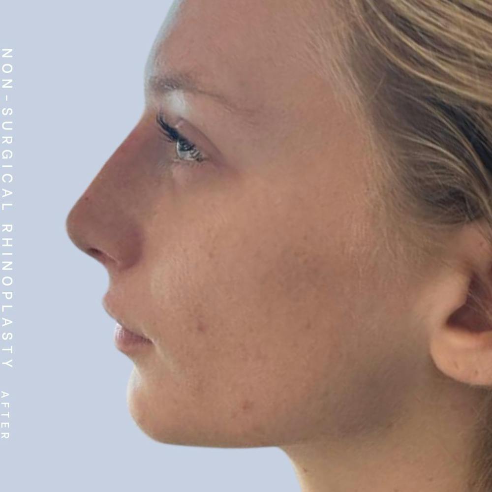 Non-Surgical Nose Before & After Gallery - Patient 142025234 - Image 4
