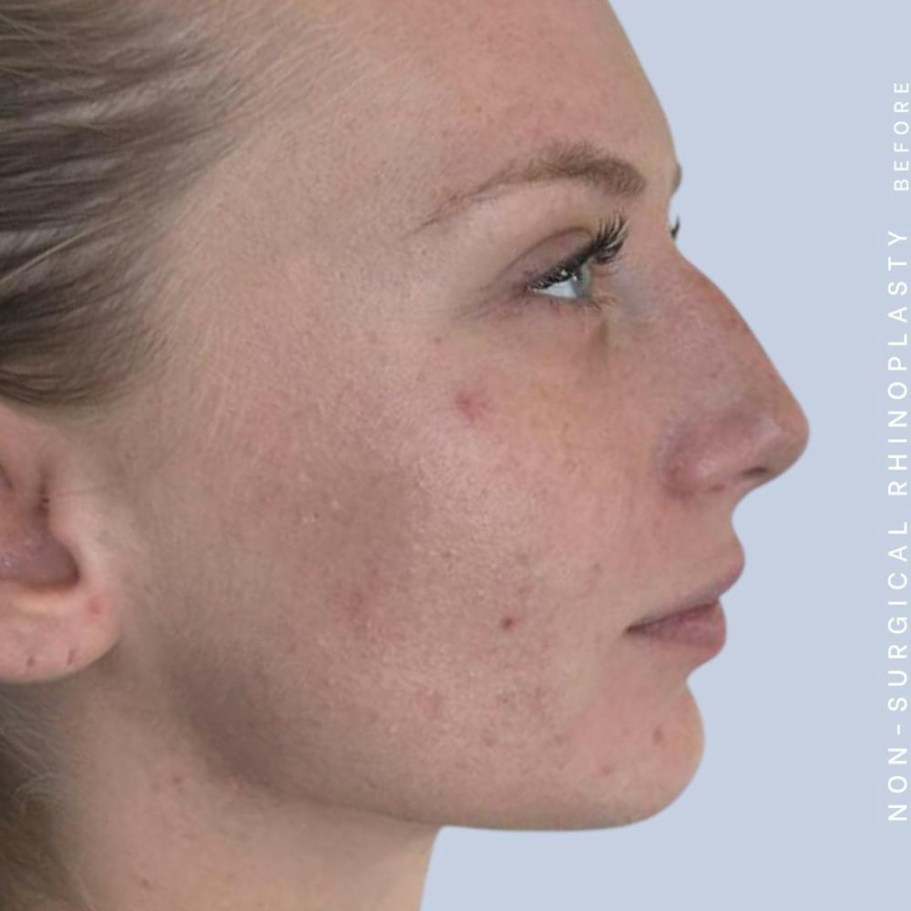 Non-Surgical Nose Before & After Gallery - Patient 142025234 - Image 5